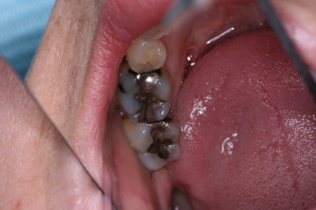 Silver Filling Replacement Before